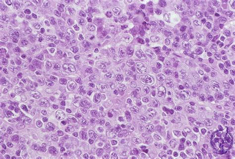 2lymph Node 8 Adult T Cell Leukemia Lymphomapathology Core Pictures