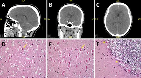 Anoxic Brain Injurya B C Postmortem Head Ct Showing Diffuse Brain