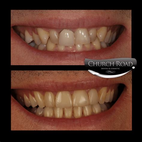 Dental Veneers Frequently Asked Questions Cheadle Dental Blog
