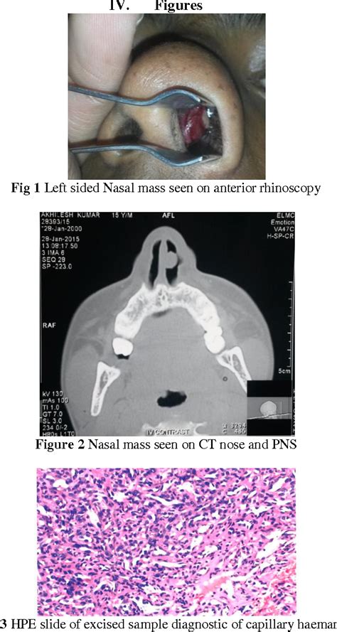 Figure 2 From Capillary Haemangioma Or Pyogenic Granuloma Of Nasal