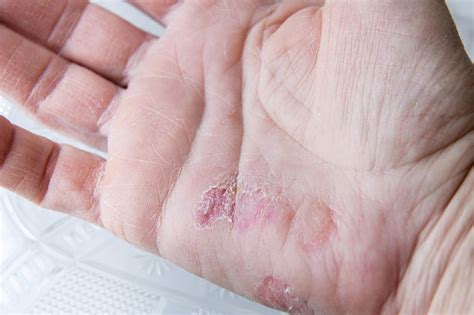 Extreme Sore Dry Cracked And Peeling Skin In The Hand Stock Photo