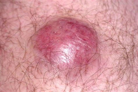 Merkel Cell Carcinoma Symptoms Treatment And More