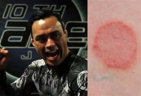 How To Avoid Ringworm From Wrestling And Bjj