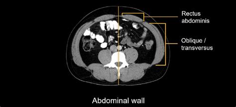 Abdominal Ct Body Wall • Litfl • Radiology Library