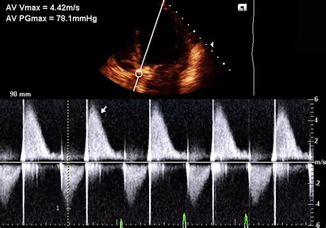 Echocardiographic Image Obtained From The Left Parasternal Window