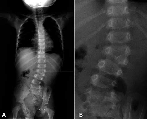 Preaxial Hand Polydactyly In Association With Lumbar Hemivertebra Bmj