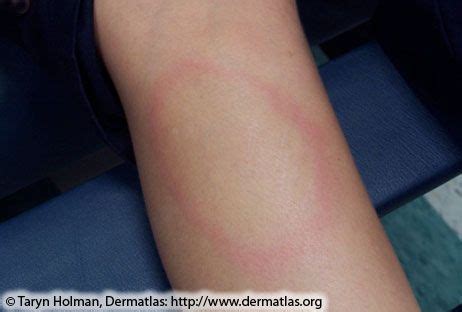 Maybe you would like to learn more about one of these? Lyme disease rashes and look-alikes | Lyme disease, Red rash, Circular pattern