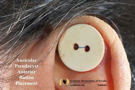 Auricular Pseudocyst Treating With Buttons Academic Dermatology Of