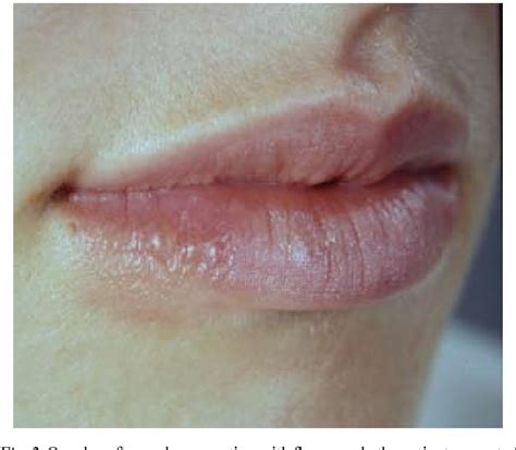 Figure 4 From A Young Woman With Recurrent Vesicles On The Lower Lip