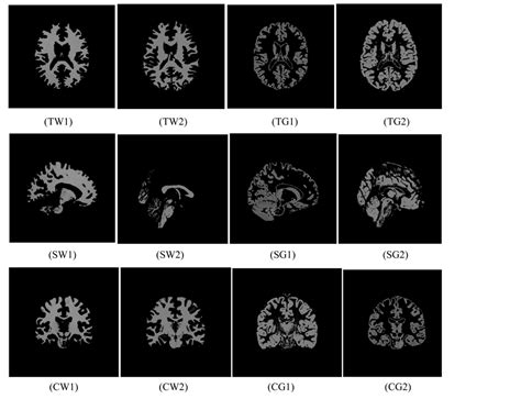 Computerized White Matter and Gray Matter Extraction from ...