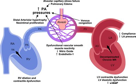 Pulmonary Hypertension In Mitral Regurgitation Journal Of The