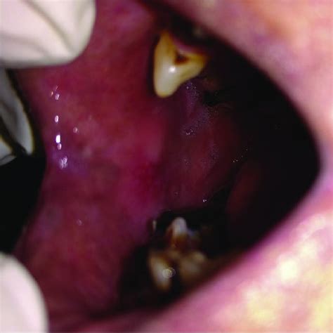 Intra Oral Photograph Of Right Buccal Mucosa With Considerable Paleness