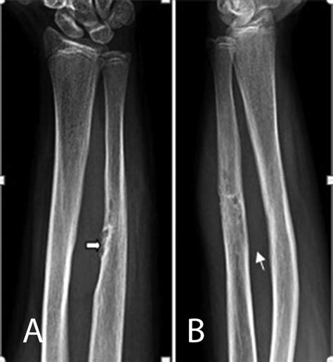 Plain Radiographs In Frontal A And Lateral B Projections Show A
