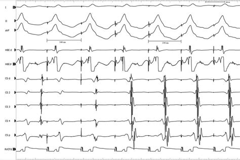 Incremental Pacing From Right Ventricular Outflow Tract Rvot Showing