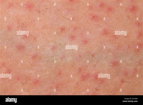 Close Up Picture Of Folliculitis Problem On Female Skin Stock Photo Alamy