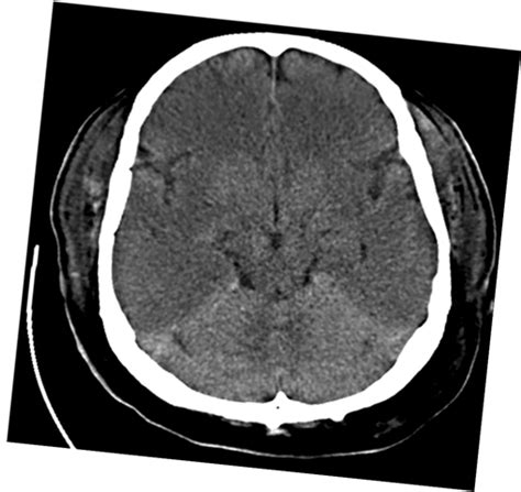 Anoxic Brain Injury Medical Osces