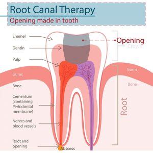 How much should a root canal and crown cost? Dental Root Canal Therapy in Edison, NJ | Dr. Isaac Menasha, DDS