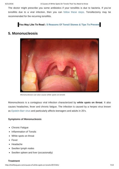 Ppt 8 Causes Of White Spots On Tonsils You May Not Know Powerpoint