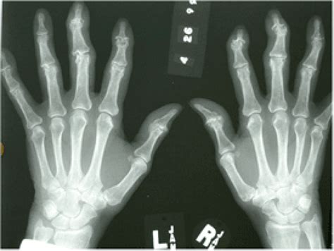 Hand Joint Arthritis Surgery Hand Surgery Associates