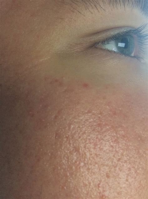 Skin Concerns My Face Feels Tight And Is Red With Very Tiny Little