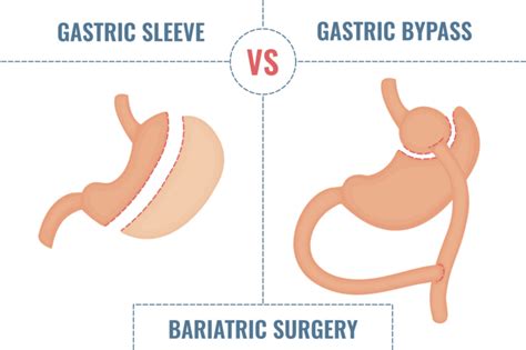 Gastric Bypass Vs Sleeve Whats The Difference 360 Sleeve Clinic