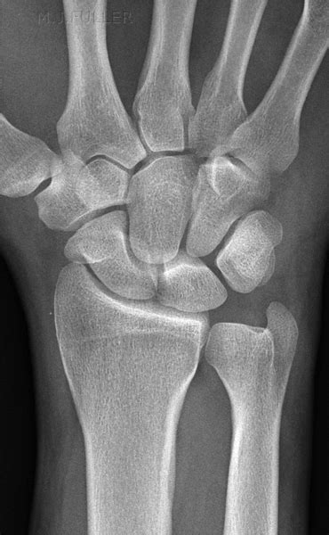 Triquetral Fractures Wikiradiography
