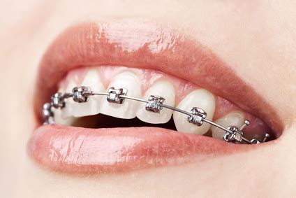 How Old Is Too Old For Braces Identity Orthodontics