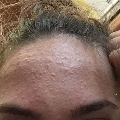 Hundreds Of Forehead Bumps I Can T Get Rue Of General Acne Discussion Acne Org