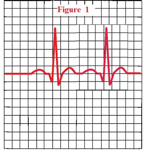 How To Measure The Pr Interval On An Ekg Strip Pr Interval Ekg Quiz