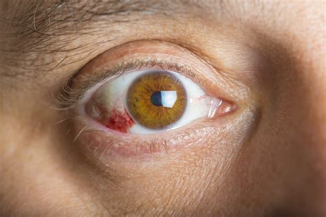 Corneal Ulcers Causes Symptoms Treatment Dean Mcgee