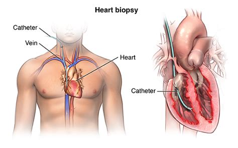 right heart catheterization with heart tissue biopsy johns hopkins medicine health library
