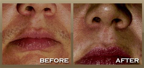 If you have unwanted hair on your face, you've probably dreamed of getting rid of it forever. Laser Hair Removal Brentwood, West Hollywood, LA | Skineccable