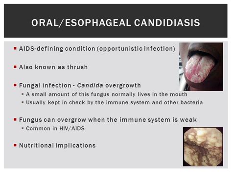 Esophageal Candidiasis And Dysphagia What Causes Yeastinfection