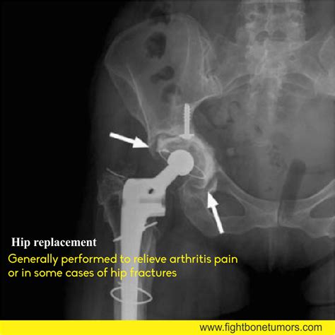 Pin On Hip Replacement