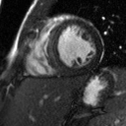 Contemporary reviews in cardiovascular medicine. Viral myocarditis (adenovirus) images, diagnosis ...