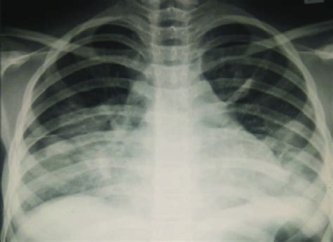 Chest X Ray Showing Cardiomegaly With Blunting Of Bilateral