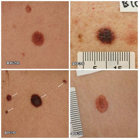 Mimics Of Skin Cancer I Skin Cancer 909