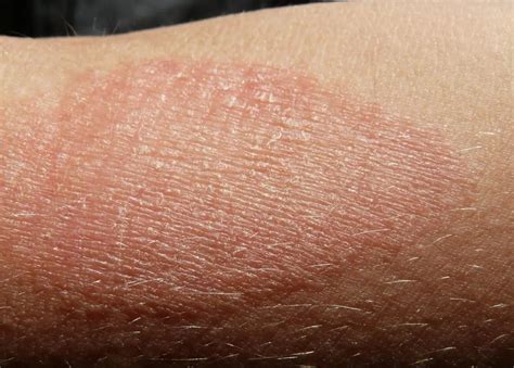 Eczema Symptoms Treatment And Causes