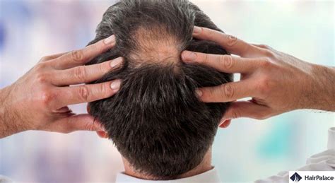 Bald Spot On Crown How To Spot It How To Stop It Hairpalace