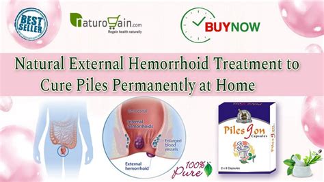 Natural External Hemorrhoid Treatment To Cure Piles Permanently At Home