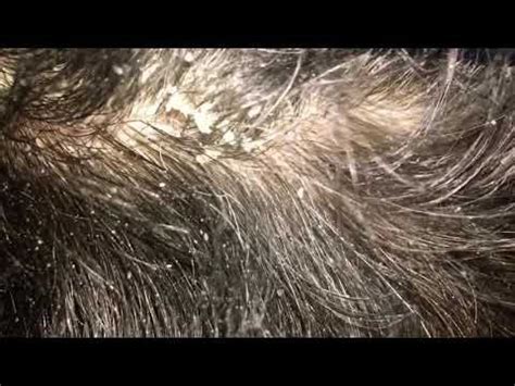 Dandruff is the excessive flaking of dead skin that forms on the scalp. 34 Dandruff Under Sew In - Sewing Wiki Source