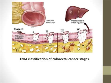 Tumour, node and metastasis (tnm) staging is one of the systems used to stage bowel (colon and rectal) cancer. malignant and benign tumors , the stages and grading of ...