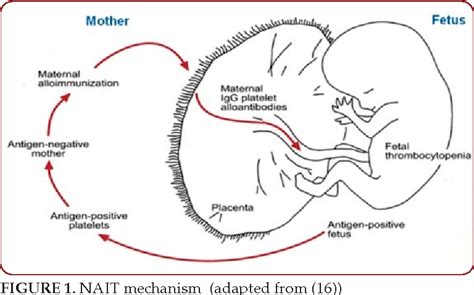 Figure 1 From Fetal And Neonatal Alloimmune Thrombocytopenia