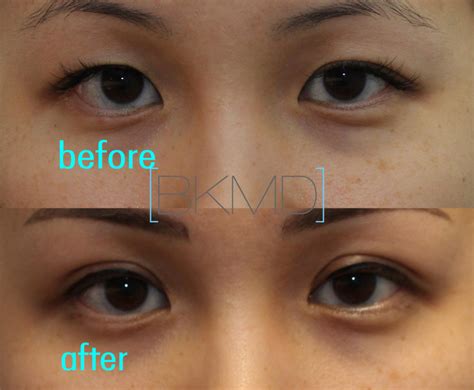 Asian Eyelid Surgery New York Cheaper Than Retail Price Buy Clothing Accessories And Lifestyle