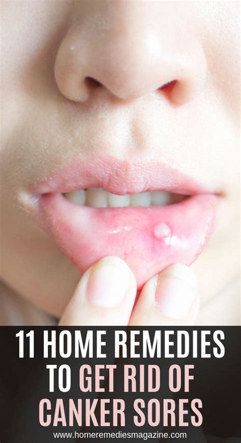 11 Home Remedies To Get Rid Of Canker Sores Importanceoforalhygiene