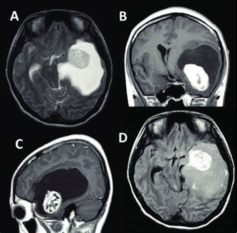 Top 92 Pictures Pictures Of Brain Tumors In Adults Latest