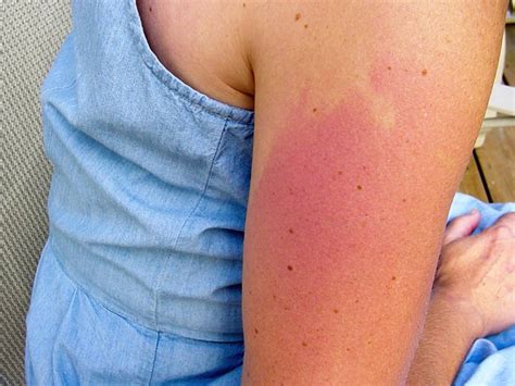 Tanning Bed Rash White Spots Heat Rash And Itchiness After Tanning