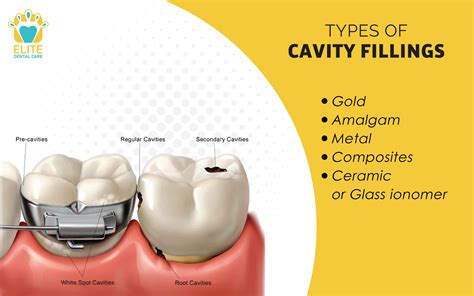 Types Of Cavity Fillings Elite Dental Care Tracy Elite Dental Care