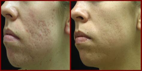 Acne Scar Laser Treatment Cosmetic Laser Institute 859