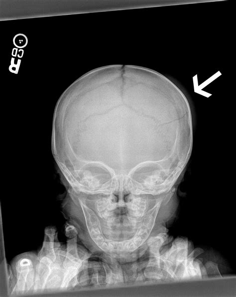 Skull Fracture In An Infant Not Visible With Computed Tomography The